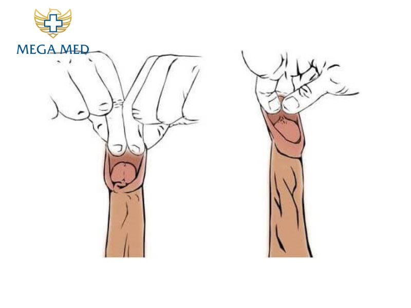 dấu hiệu sắp lột bao quy đầu ở nam giới
